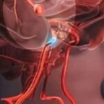 Aneurysm: Signs You Shouldn’t Ignore